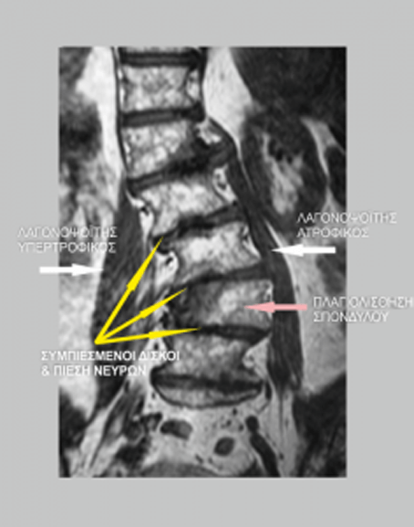 Adult scoliosis treatment