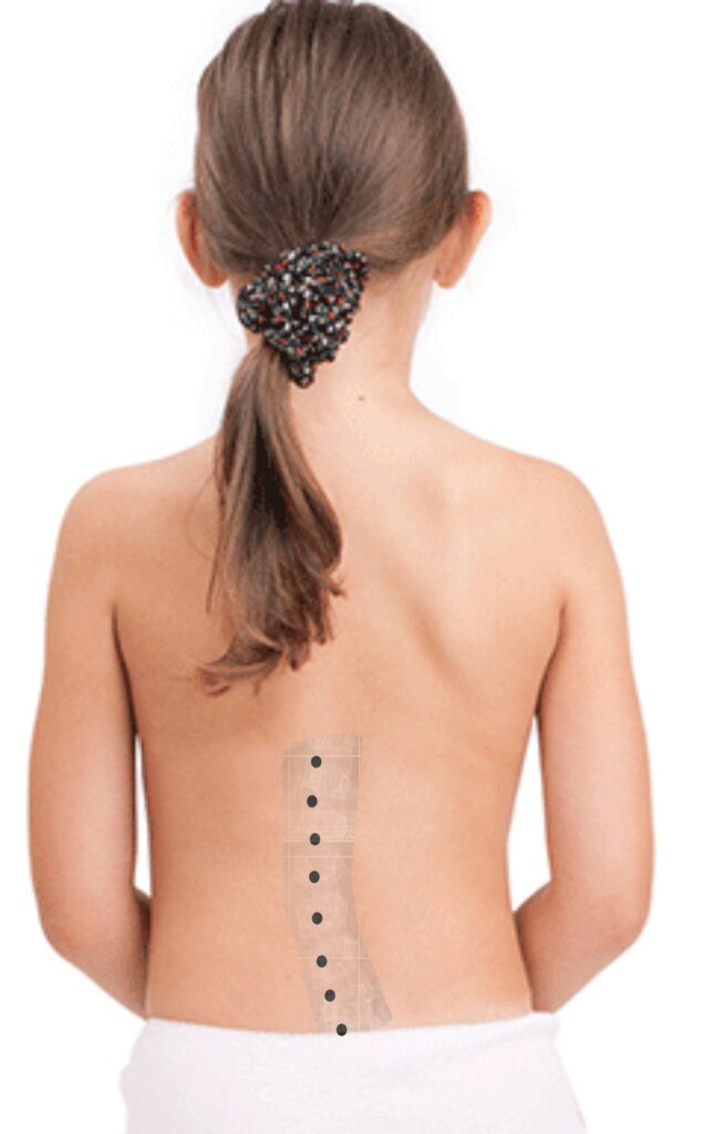 girl low scoliosis h